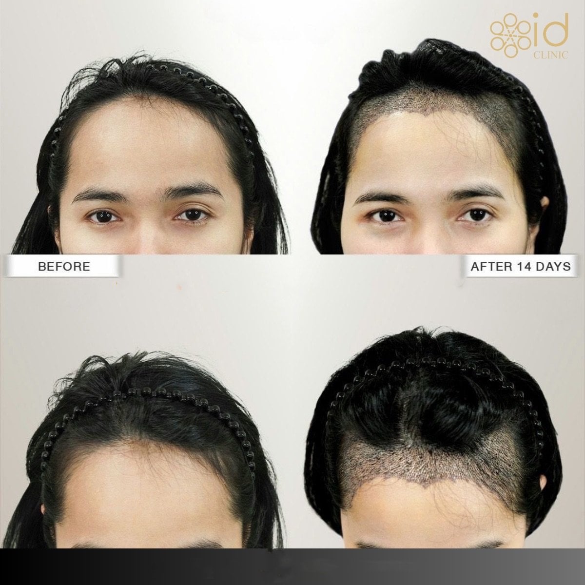 Antes y después de trasplante capilar FUE en ID Clinic Bangkok, resultado visible de restauración capilar