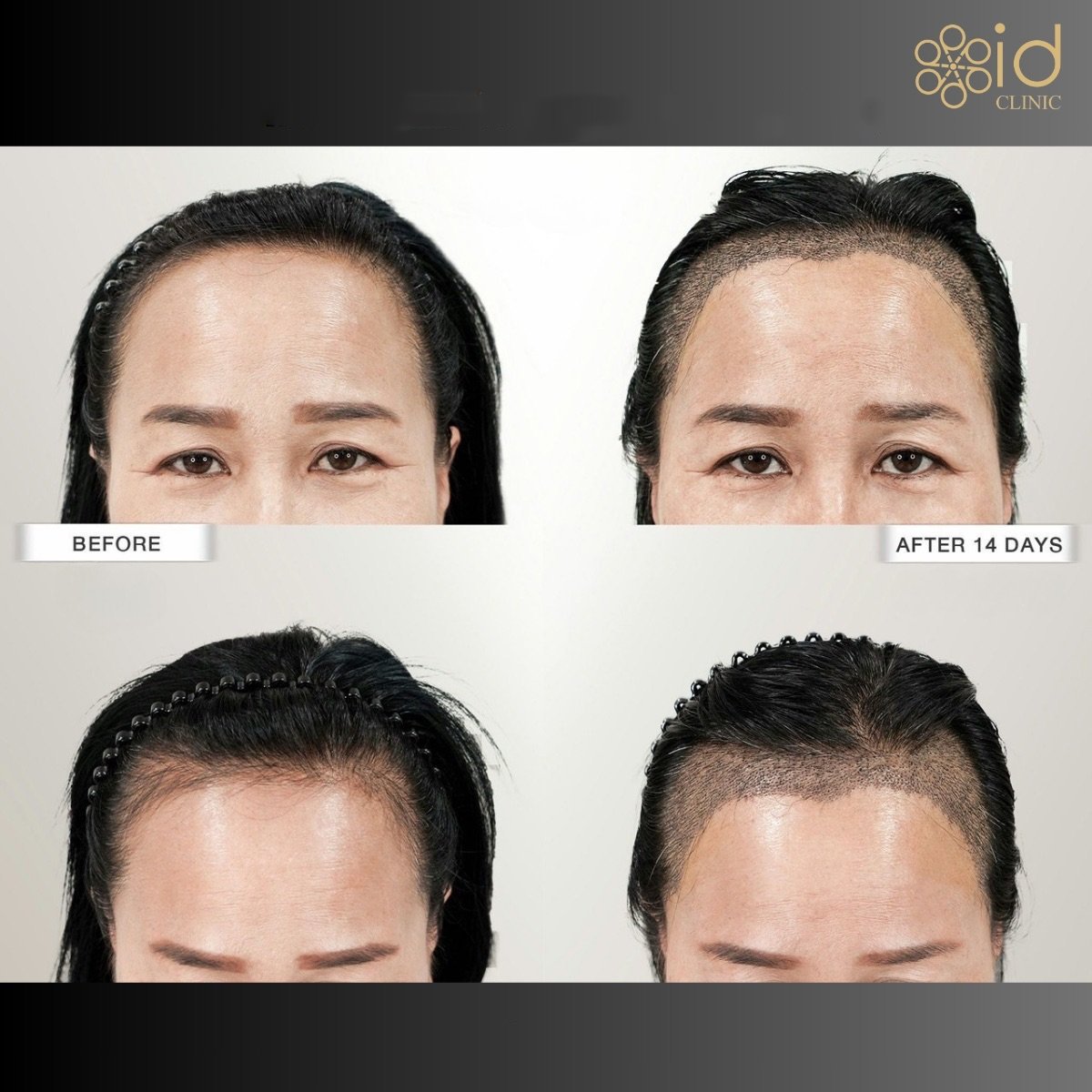 نتائج زراعة الشعر FUE قبل وبعد في ID Clinic Bangkok، تحسن واضح في خط الشعر