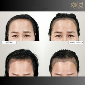 Before and after FUE hair transplant results at ID Clinic Bangkok, visible hairline improvement