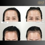 Before and after FUE hair transplant results at ID Clinic Bangkok, visible hairline improvement
