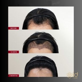 FUE hair transplant before and after results at ID Clinic Bangkok, improved hairline in 8 months