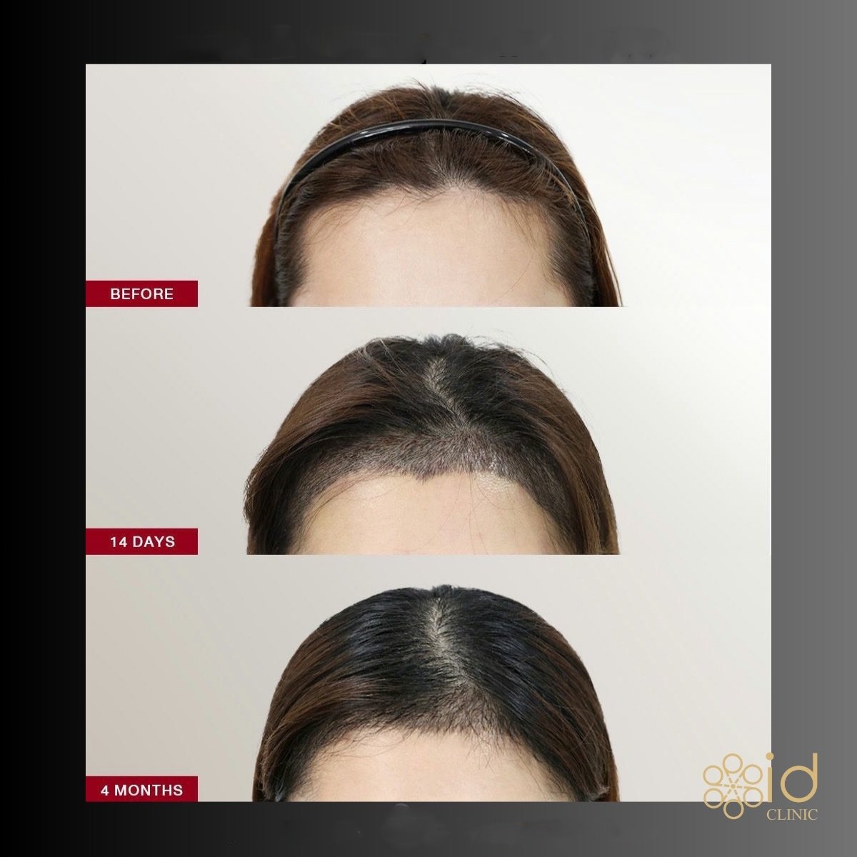 نتائج زراعة الشعر FUE قبل وبعد في ID Clinic Bangkok، تحسن واضح في خط الشعر