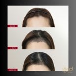 FUE hair transplant before and after results at ID Clinic Bangkok, visible hairline improvement