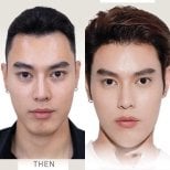 Before and after facial contouring results at ID Clinic Bangkok, enhanced jawline and features
