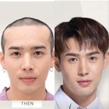 Before and after FUE hair transplant result at ID Clinic Bangkok, restored fuller hairline