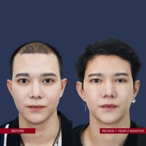 Before and after hair transplant results at ID Clinic Bangkok, fuller hairline after 1 year