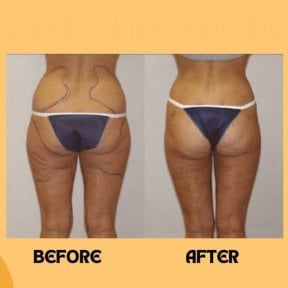 Before and after thigh lift results at ID Clinic Bangkok, improved thigh contour and firmness