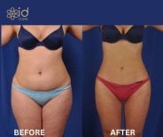 Before and after thigh lift results at ID Clinic Bangkok, improved thigh contour and shape