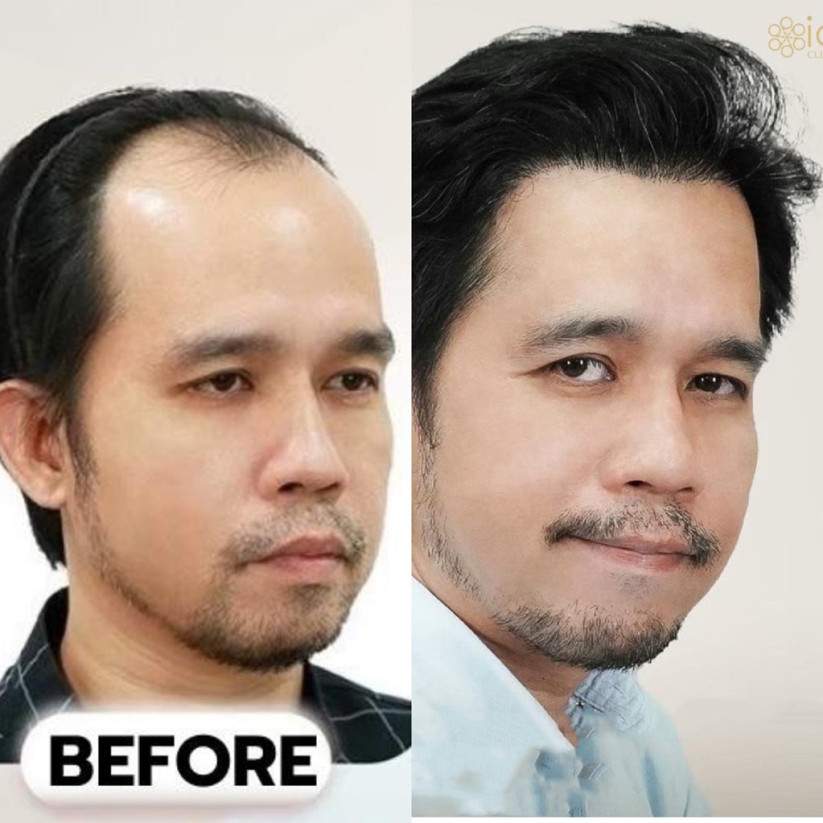 نتيجة زراعة الشعر FUE قبل وبعد في ID Clinic Bangkok، استعادة خط الشعر الممتلئ