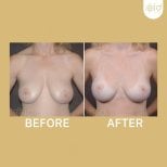 Before and after breast implants with lift at ID Clinic Bangkok, enhanced breast shape result