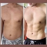 Before and after 360 liposuction results at ID Clinic Bangkok, improved male abdominal contour