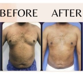 360 liposuction before and after results at ID Clinic Bangkok, visible body contour improvement