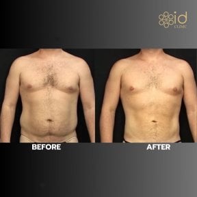 Before and after 360 liposuction results at ID Clinic Bangkok, improved male body contour