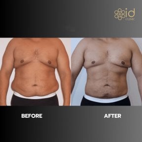 Before and after 360 liposuction results at ID Clinic Bangkok, improved body contour