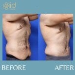 Before and after 360 liposuction results at ID Clinic Bangkok, improved abdominal contour