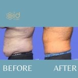 Before and after 360 liposuction results at ID Clinic Bangkok, improved abdominal contour