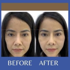 Facelift before and after results at ID Clinic Bangkok, visible facial rejuvenation and lift