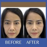 Facelift before and after results at ID Clinic Bangkok, visible facial rejuvenation and lift