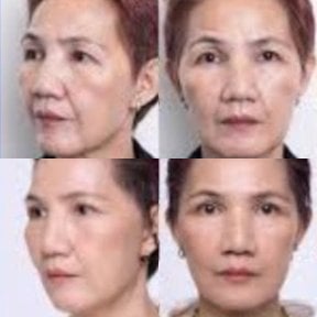 Before and after facelift results at ID Clinic Bangkok, visible facial rejuvenation and lift