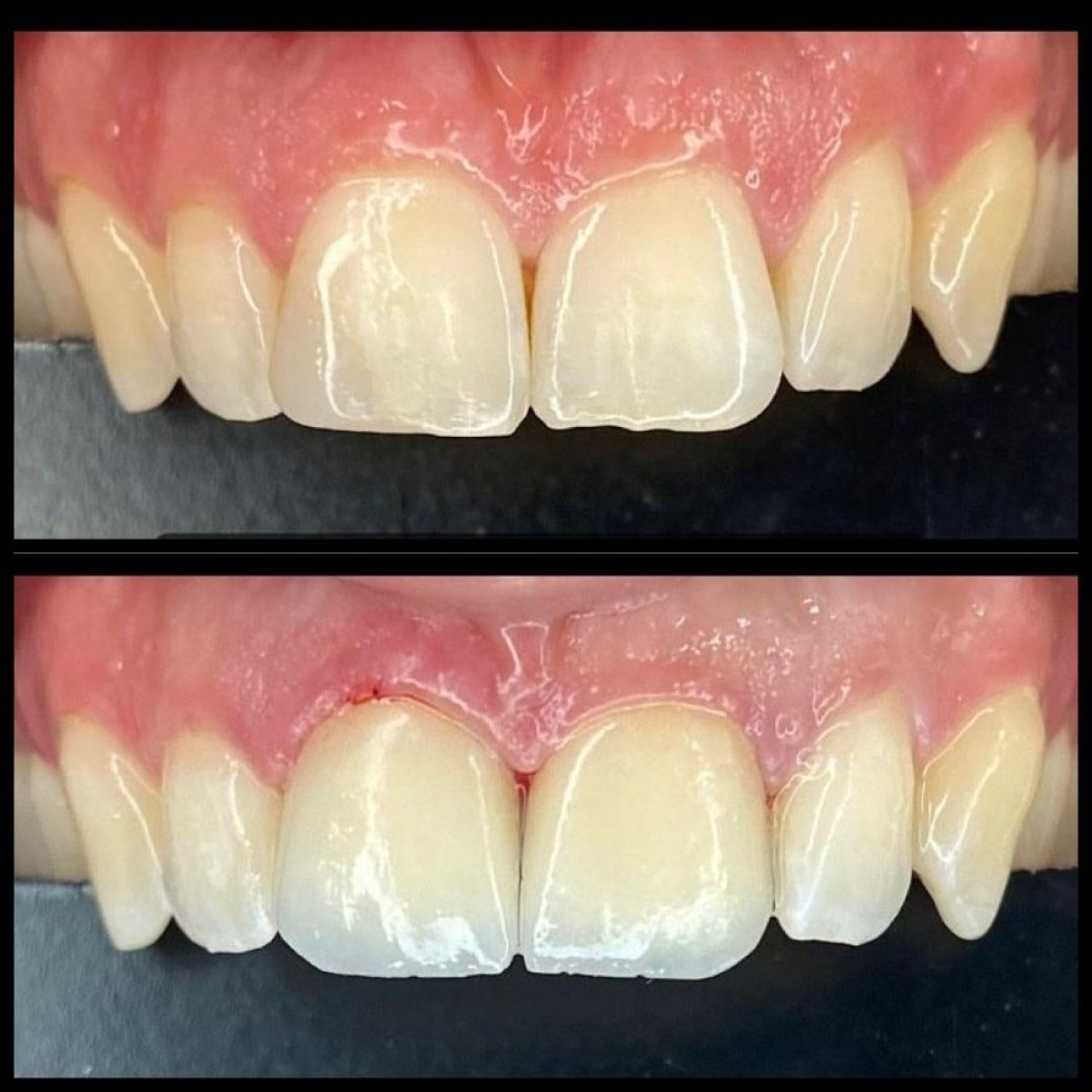 Résultats avant et après bonding dentaire à la clinique privée Dr Ela Cabuk Renklibay