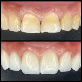 Résultats avant et après bonding dentaire à la clinique privée Dr Ela Cabuk Renklibay