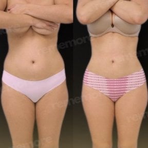 Before and after Renuvion J Plasma body contouring results at Memorial Şişli Hospital