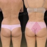 Before and after Renuvion J Plasma body contouring results at Memorial Şişli Hospital