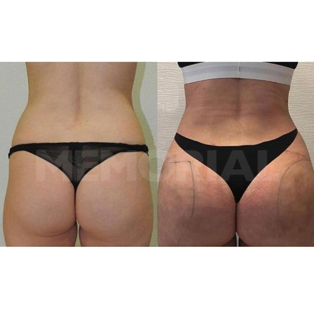 نتائج قبل وبعد عملية Brazilian Butt Lift في مستشفى Memorial Şişli، تحسين المنحنيات