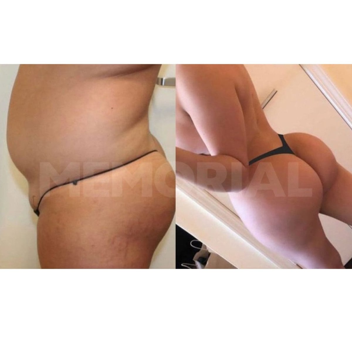 نتائج قبل وبعد عملية Brazilian Butt Lift في مستشفى Memorial Şişli، تحسين شكل الجسم