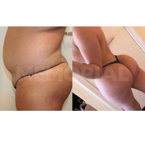 Before and after Brazilian Butt Lift results at Memorial Şişli Hospital, enhanced body contour