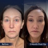 Before and after neck lift results at Dr. Safa Manav Clinic, visible facial rejuvenation