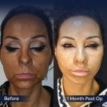 Facelift before and after results at Dr. Safa Manav Clinic, visible facial rejuvenation