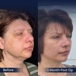 Before and after neck lift results at Dr. Safa Manav Clinic, visible jawline and neck contour