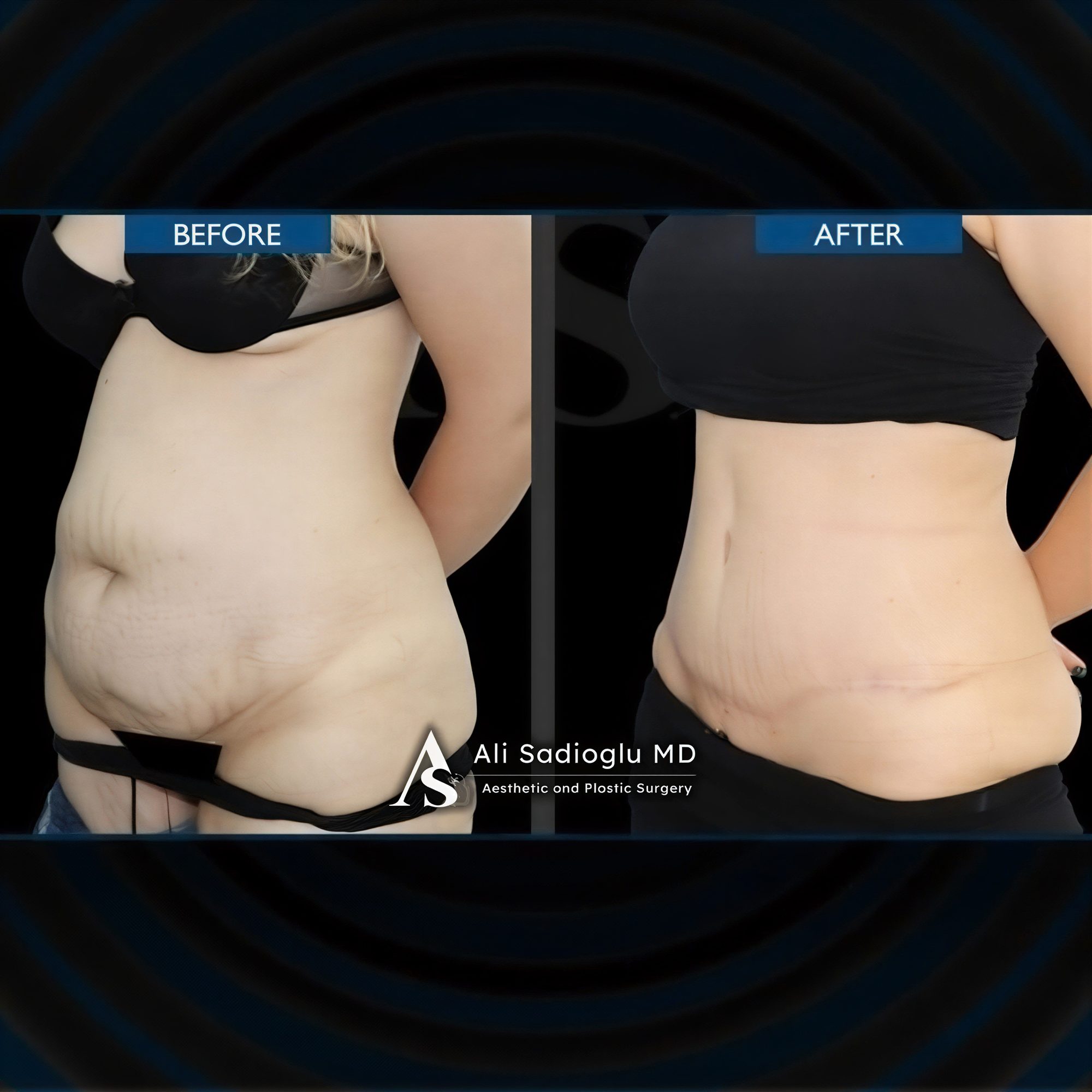 Resultados de abdominoplastia antes y después en Dr. Safa Manav Clinic, contorno abdominal visible