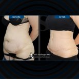 Vorher-nachher-Ergebnis Bauchdeckenstraffung bei Dr. Safa Manav Clinic, sichtbare Kontur