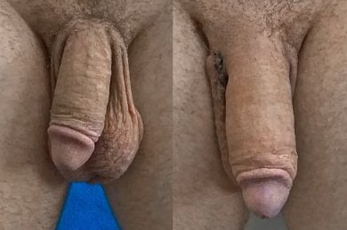 نتائج قبل وبعد جراحة تكبير القضيب Himplant في عيادة Uroaesthetic