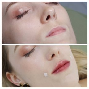 Vorher-nachher-Ergebnis Lip Lift bei Plenary Wellness, verbesserte Lippenkontur sichtbar