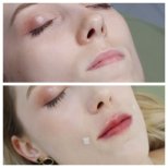 Vorher-nachher-Ergebnis Lip Lift bei Plenary Wellness, verbesserte Lippenkontur sichtbar