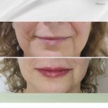 Vorher-nachher-Ergebnis Lippenlifting bei Plenary Wellness, verbesserte Lippenkontur