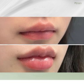 Vorher-nachher-Ergebnis Lip Lift bei Plenary Wellness, verbesserte Lippenform und Volumen