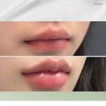 Vorher-nachher-Ergebnis Lip Lift bei Plenary Wellness, verbesserte Lippenform und Volumen