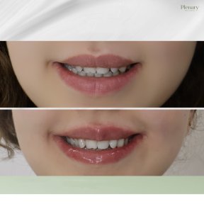 Vorher-nachher-Ergebnis Lip Lift bei Plenary Wellness, verbesserte Oberlippenkontur
