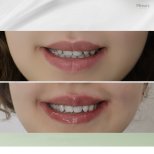Vorher-nachher-Ergebnis Lip Lift bei Plenary Wellness, verbesserte Oberlippenkontur
