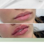 Vorher-nachher-Ergebnis Lip Lift bei Plenary Wellness, verbesserte Lippenform und Volumen