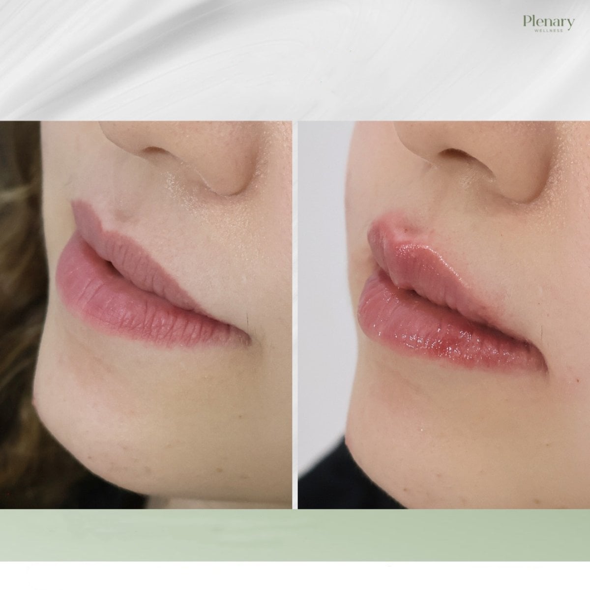 Resultados de antes y después de lip lift en Plenary Wellness, mejor contorno y volumen labial