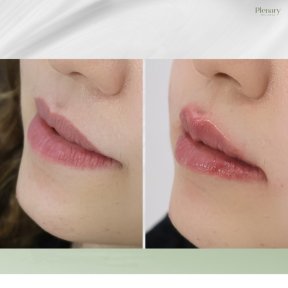 Vorher-nachher-Ergebnis Lip Lift bei Plenary Wellness, verbesserte Lippenkontur und Volumen