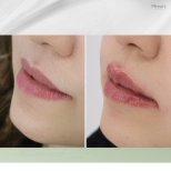 Vorher-nachher-Ergebnis Lip Lift bei Plenary Wellness, verbesserte Lippenkontur und Volumen