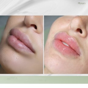 Vorher-nachher-Ergebnis Lip Lift bei Plenary Wellness – verbesserte Lippenkontur und Volumen
