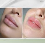 Vorher-nachher-Ergebnis Lip Lift bei Plenary Wellness – verbesserte Lippenkontur und Volumen