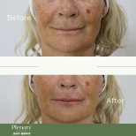Vorher-nachher-Ergebnis Lippenlifting bei Plenary Wellness, verbesserte Lippenkontur